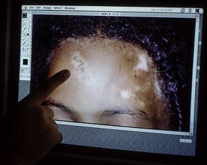 A person points at the screen image of a rash on someone's forehead
