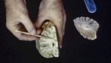 Demonstration of the location of a lobotomy using a model of the brain.